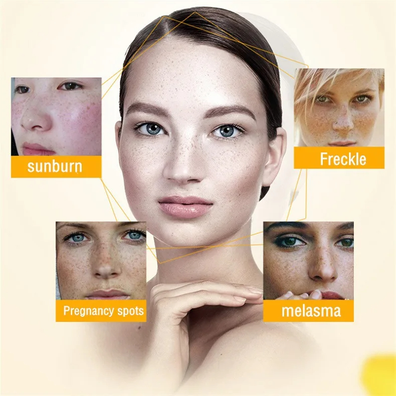 Whitening Freckle Cream Remove - Photography Treatment avis et prix