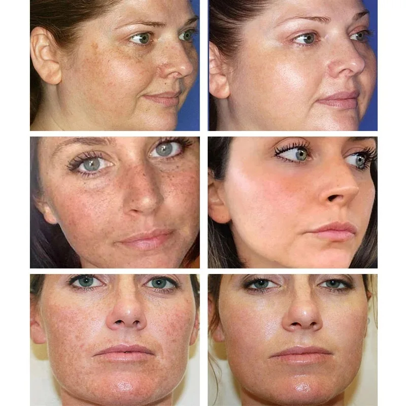 Whitening Freckle Cream Remove - Photography Treatment avis et prix